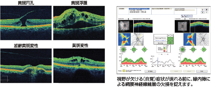 各種目の病気の断面像